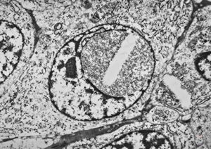 M,62y. | plasmocytoma - nasal cavity M,62y. | plasmocytoma - nasal cavity